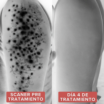 Strawberry™  | Alivia la Queratosis Pilaris desde la raíz