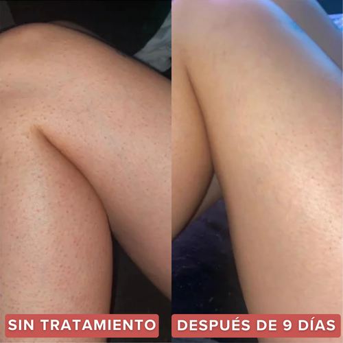 Strawberry™  | Alivia la Queratosis Pilaris desde la raíz